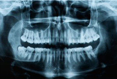 PANORAMICA DENTALE OPT